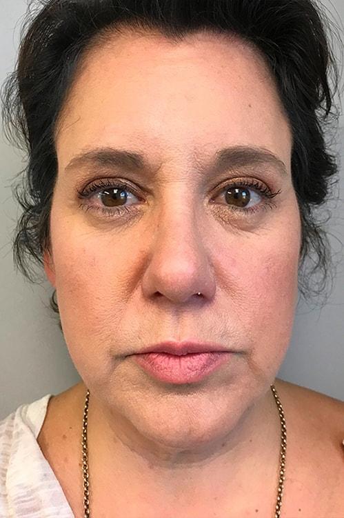 Facelift before at Shervin Aminpour, MD in Los Angeles, CA