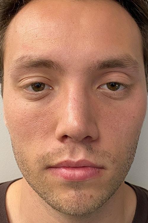 Shervin Aminpour, MD rhinoplasty after — Los Angeles, CA