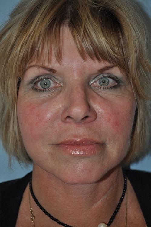Shervin Aminpour, MD facelift after — Los Angeles, CA