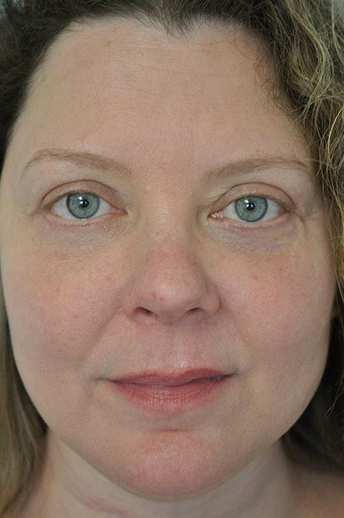 Shervin Aminpour, MD facelift after — Los Angeles, CA