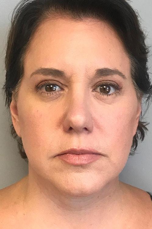 Facelift after at Shervin Aminpour, MD in Los Angeles, CA