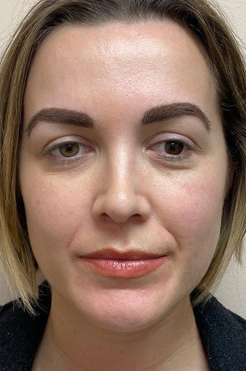 Shervin Aminpour, MD rhinoplasty after — Los Angeles, CA