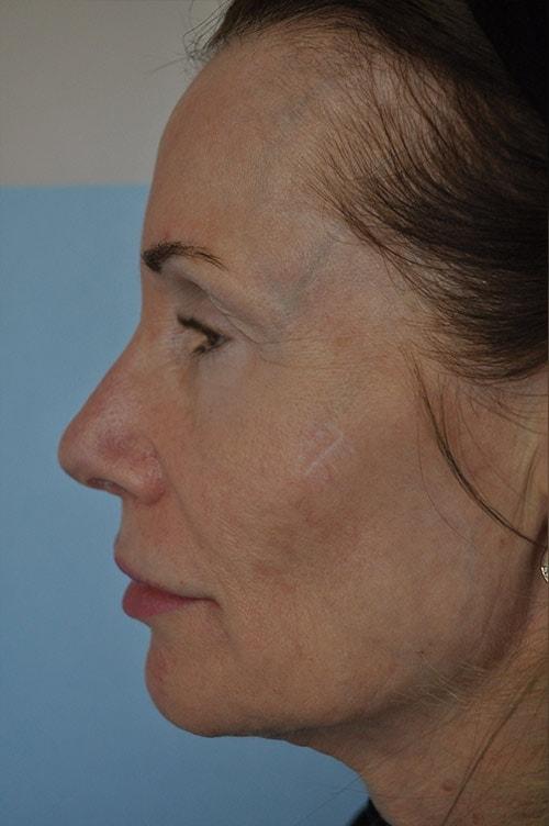 Shervin Aminpour, MD rhinoplasty after — Los Angeles, CA