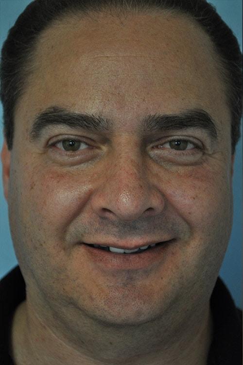 Shervin Aminpour, MD rhinoplasty after — Los Angeles, CA