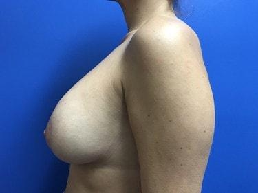 Breast Lift after at Ghada Y. Afifi, MD, FACS in Newport Beach, CA