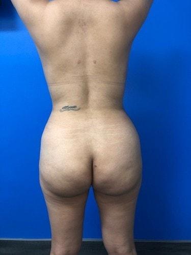 Brazilian Butt Lift after at Ghada Y. Afifi, MD, FACS in Newport Beach, CA