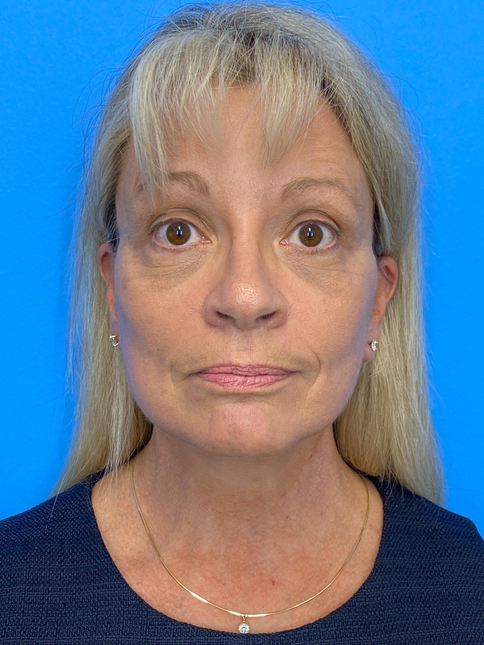 Des Moines Plastic Surgery facelift after — West Des Moines, IA