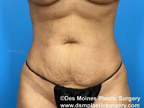Tummy Tuck before at Des Moines Plastic Surgery in West Des Moines, IA