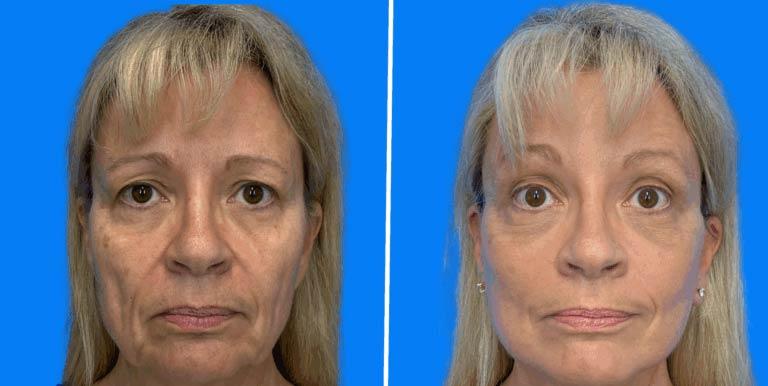 Des Moines Plastic Surgery facelift result — West Des Moines, IA