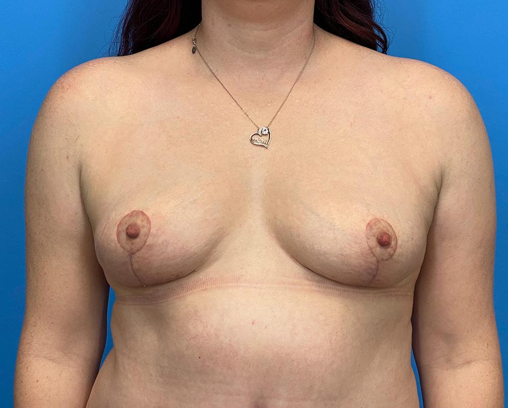 Des Moines Plastic Surgery breast lift result — West Des Moines, IA