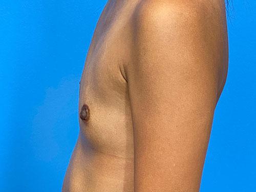 Fat Transfer Breast Augmentation before at Des Moines Plastic Surgery in West Des Moines, IA