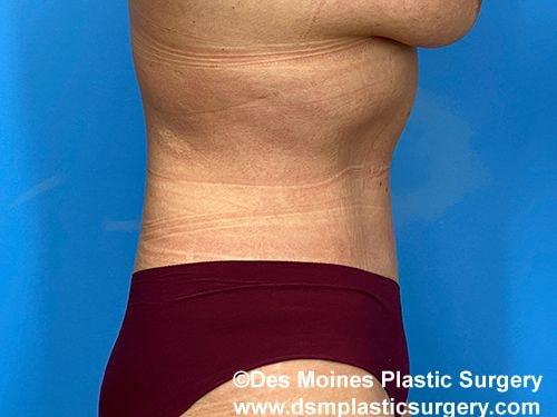 Des Moines Plastic Surgery tummy tuck after — West Des Moines, IA