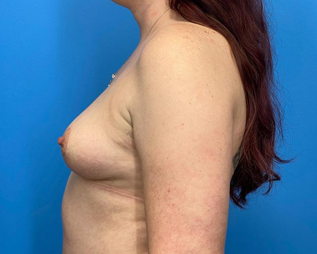 Breast Reduction result at Des Moines Plastic Surgery in West Des Moines, IA