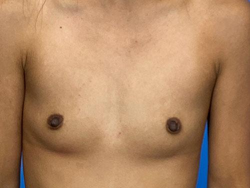 Fat Transfer Breast Augmentation before at Des Moines Plastic Surgery in West Des Moines, IA