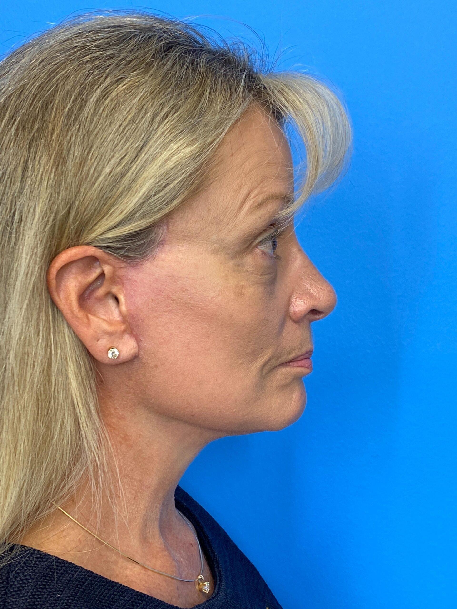 Des Moines Plastic Surgery facelift after — West Des Moines, IA