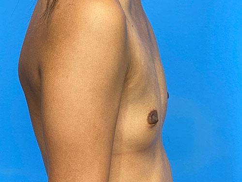 Fat Transfer Breast Augmentation before at Des Moines Plastic Surgery in West Des Moines, IA