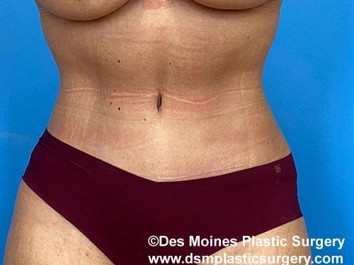 Tummy Tuck after at Des Moines Plastic Surgery in West Des Moines, IA