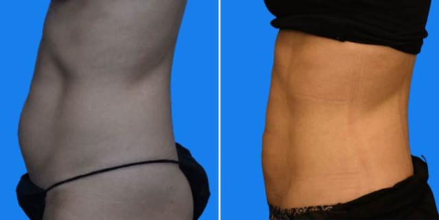 Brazilian Butt Lift result at Des Moines Plastic Surgery in West Des Moines, IA