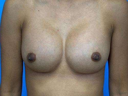 Fat Transfer Breast Augmentation after at Des Moines Plastic Surgery in West Des Moines, IA