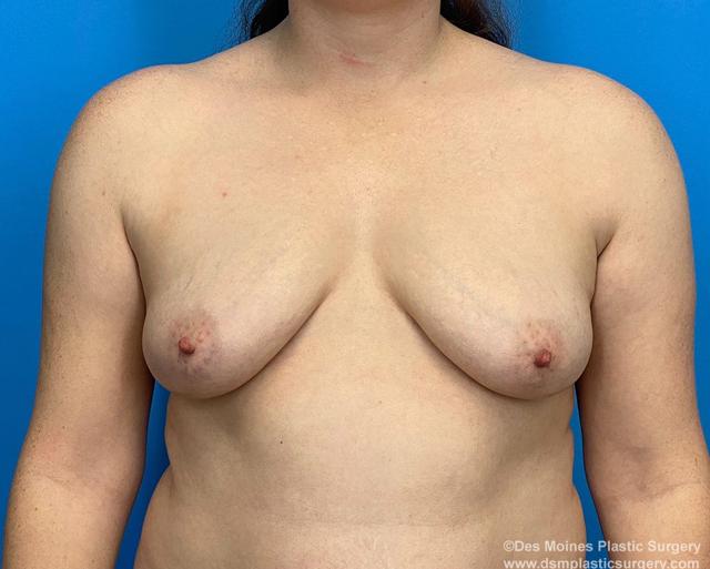Breast Reduction before at Des Moines Plastic Surgery in West Des Moines, IA