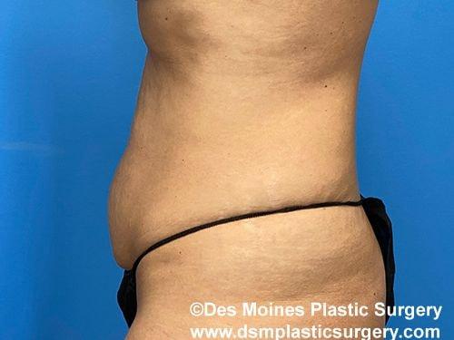 Tummy Tuck before at Des Moines Plastic Surgery in West Des Moines, IA
