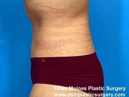 Tummy Tuck after at Des Moines Plastic Surgery in West Des Moines, IA