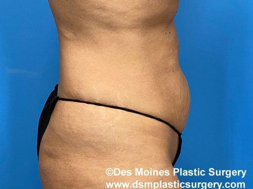 Tummy Tuck before at Des Moines Plastic Surgery in West Des Moines, IA