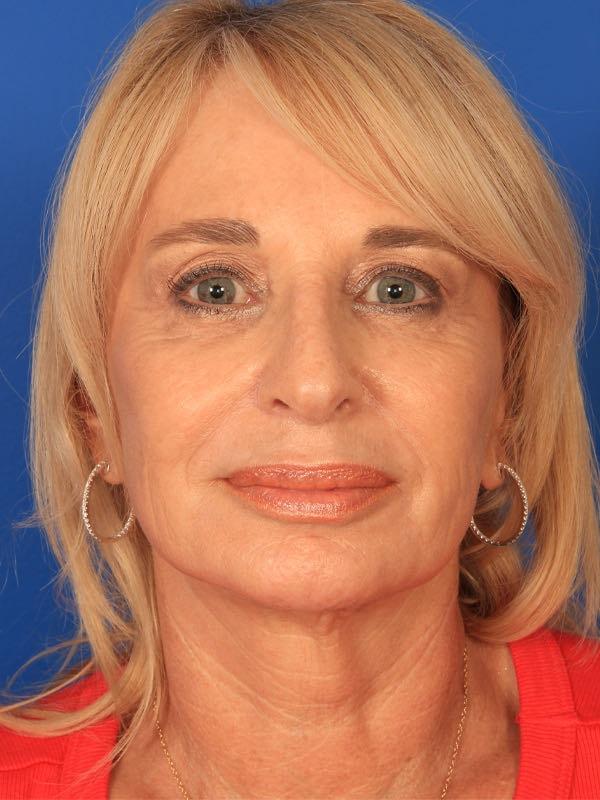 Brow Lift before at Farrior Facial Plastic Surgery in Tampa, FL