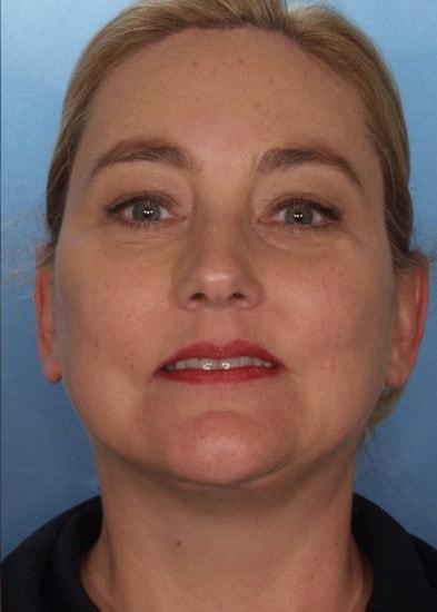 Farrior Facial Plastic Surgery facelift after — Tampa, FL