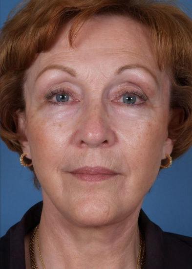 Farrior Facial Plastic Surgery facelift after — Tampa, FL
