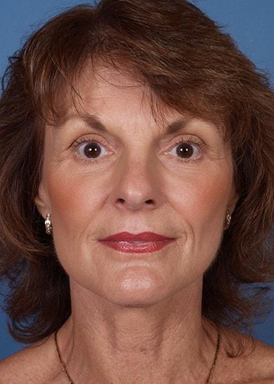 Farrior Facial Plastic Surgery facelift after — Tampa, FL