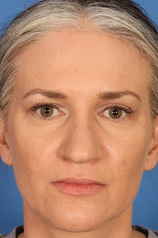 Laser Skin Resurfacing before at Farrior Facial Plastic Surgery in Tampa, FL