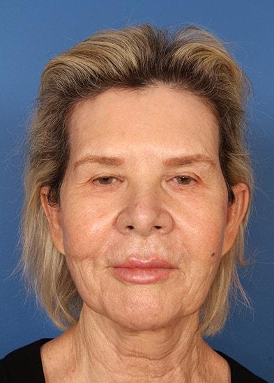 Brow Lift before at Farrior Facial Plastic Surgery in Tampa, FL
