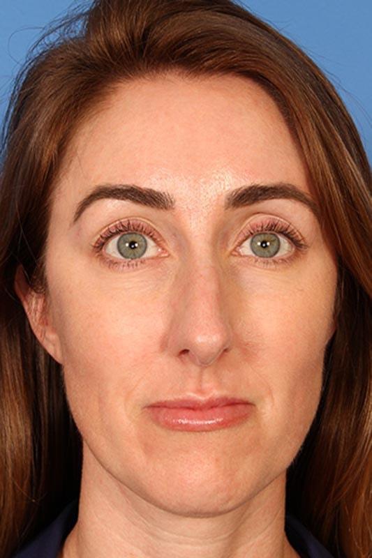 Rhinoplasty before at Farrior Facial Plastic Surgery in Tampa, FL