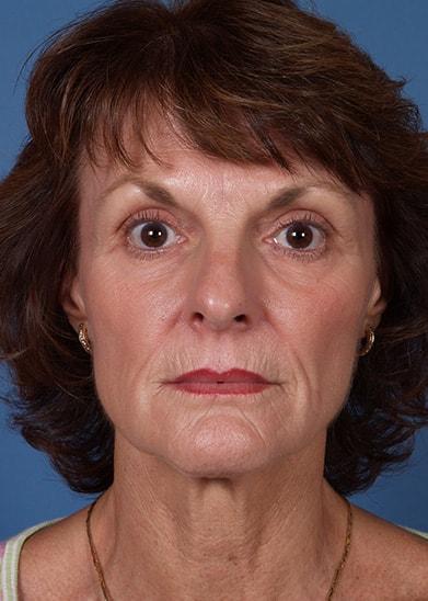 Neck Lift before at Farrior Facial Plastic Surgery in Tampa, FL