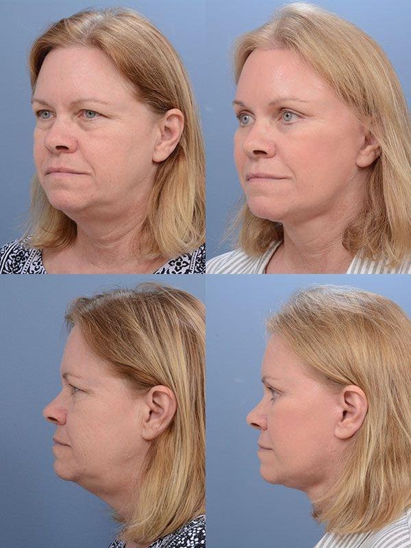 Ernesto J Ruas, MD facelift result — Tampa, FL