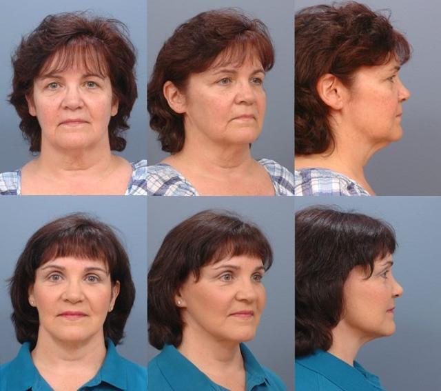 Neck Lift result at Ernesto J Ruas, MD in Tampa, FL