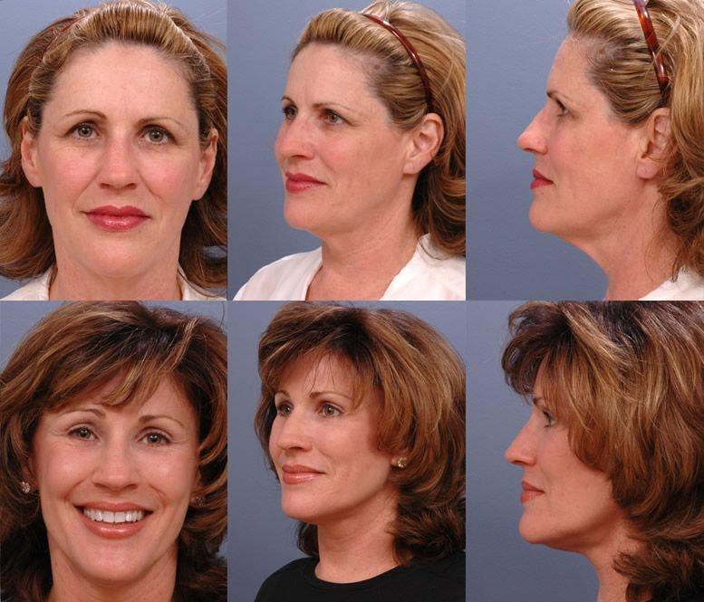 Ernesto J Ruas, MD facelift result — Tampa, FL