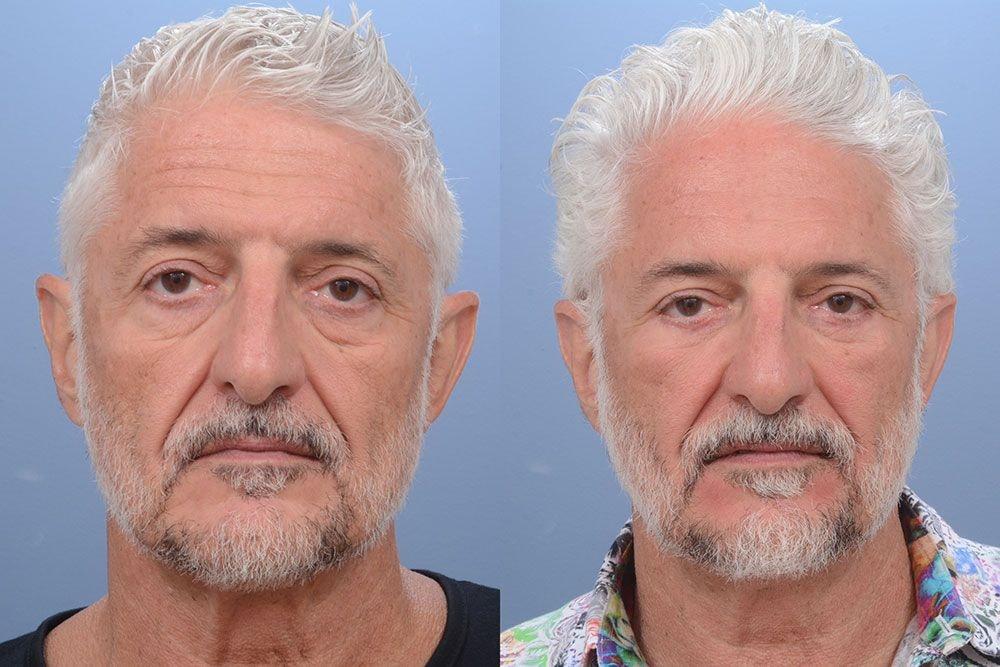 Ernesto J Ruas, MD brow lift result — Tampa, FL