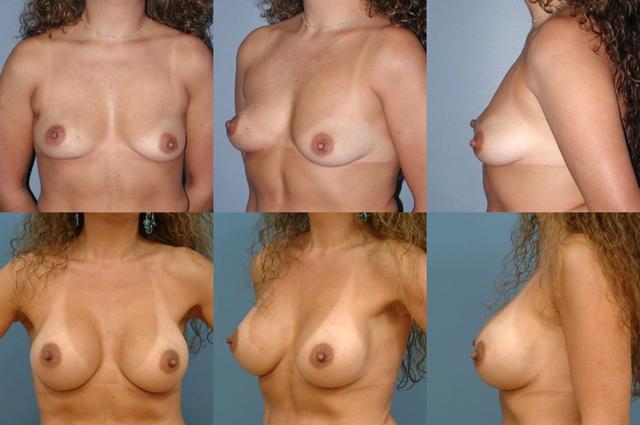 Fat Transfer Breast Augmentation result at Ernesto J Ruas, MD in Tampa, FL