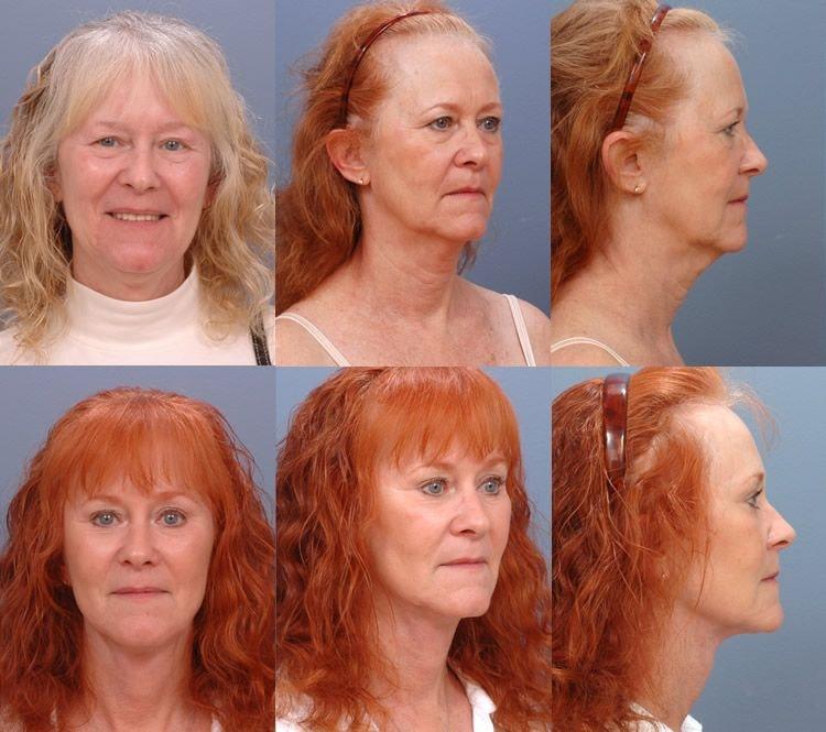 Ernesto J Ruas, MD facelift result — Tampa, FL