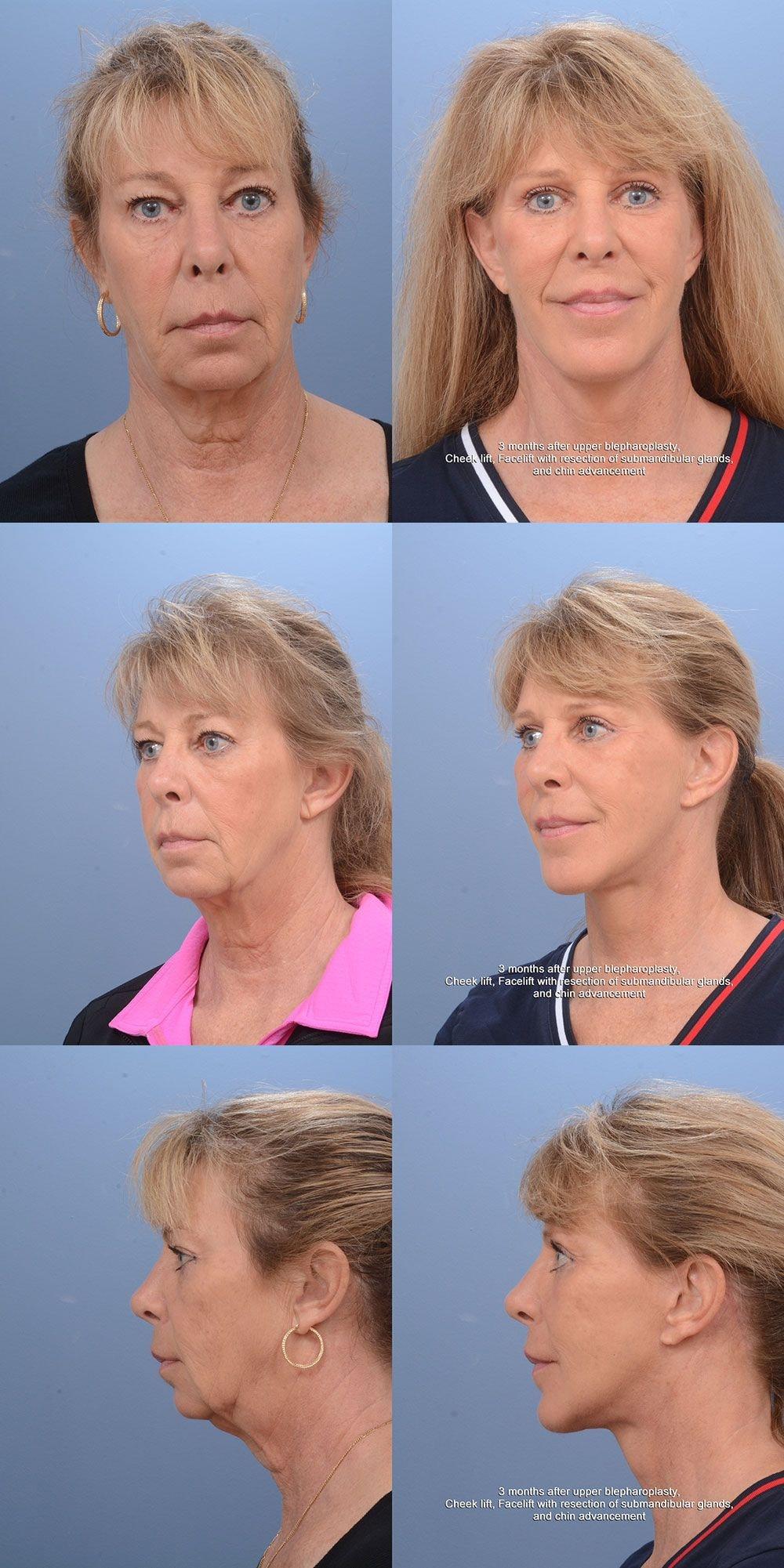 Ernesto J Ruas, MD facelift result — Tampa, FL