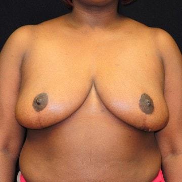 Lawrence R. Sirota, DO breast reduction after — Albertson, NY