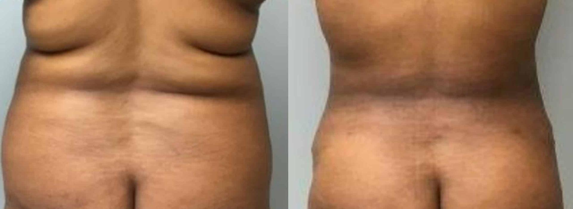 John Reilly MD Plastic Surgeon liposuction result — Bedford, NH