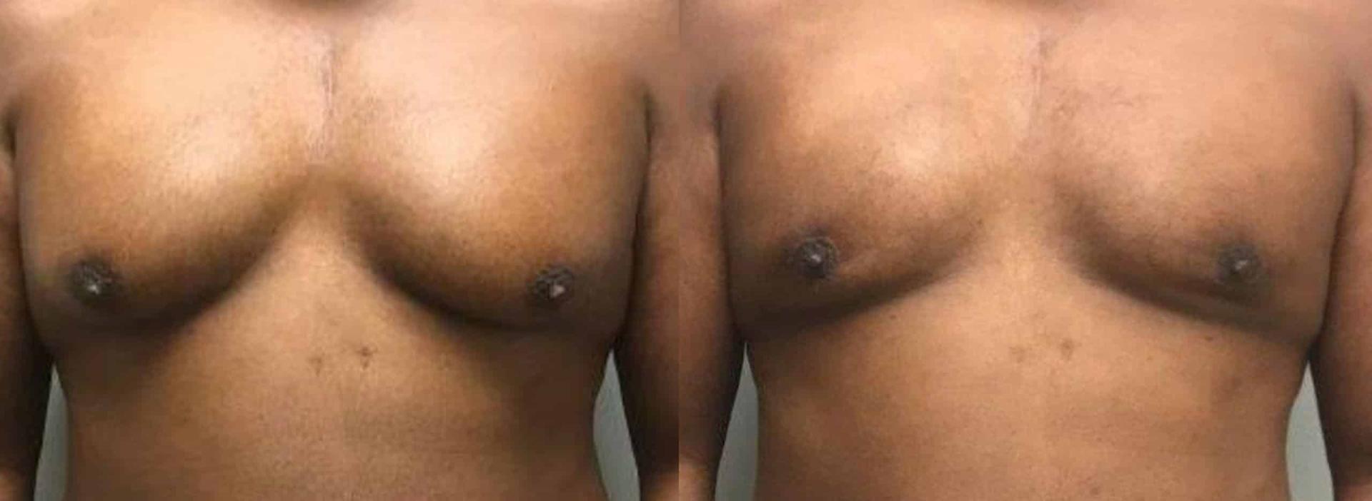 John Reilly MD Plastic Surgeon gynecomastia result — Bedford, NH