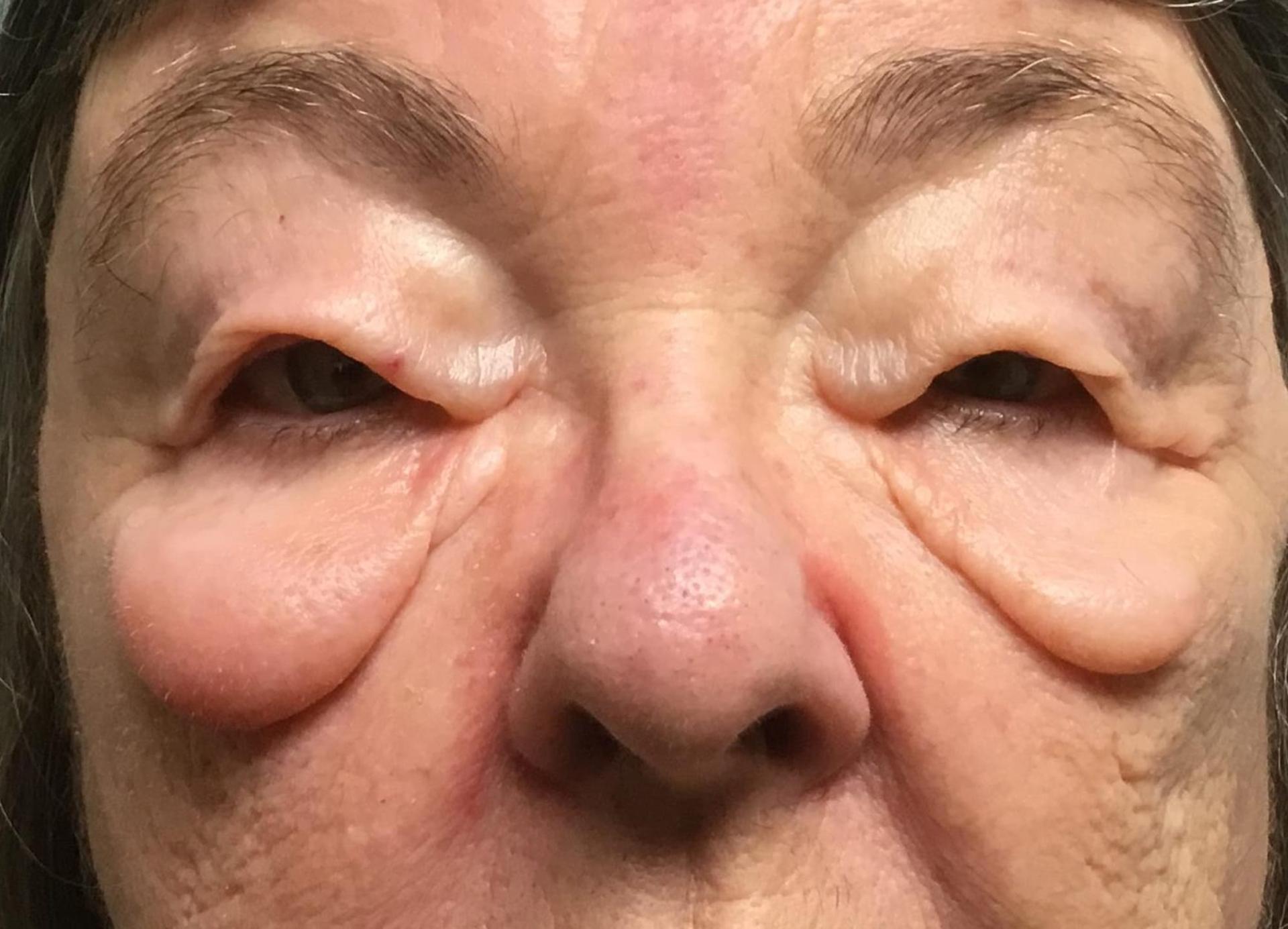 John Reilly MD Plastic Surgeon eyelid lift result — Bedford, NH