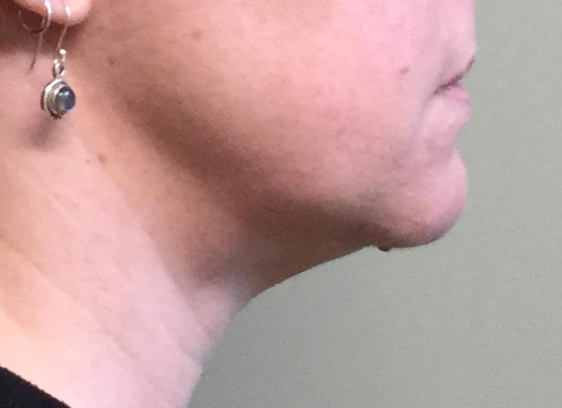 John Reilly MD Plastic Surgeon liposuction result — Bedford, NH