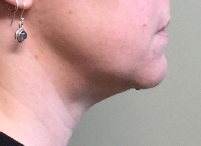 Liposuction result at John Reilly MD Plastic Surgeon in Bedford, NH