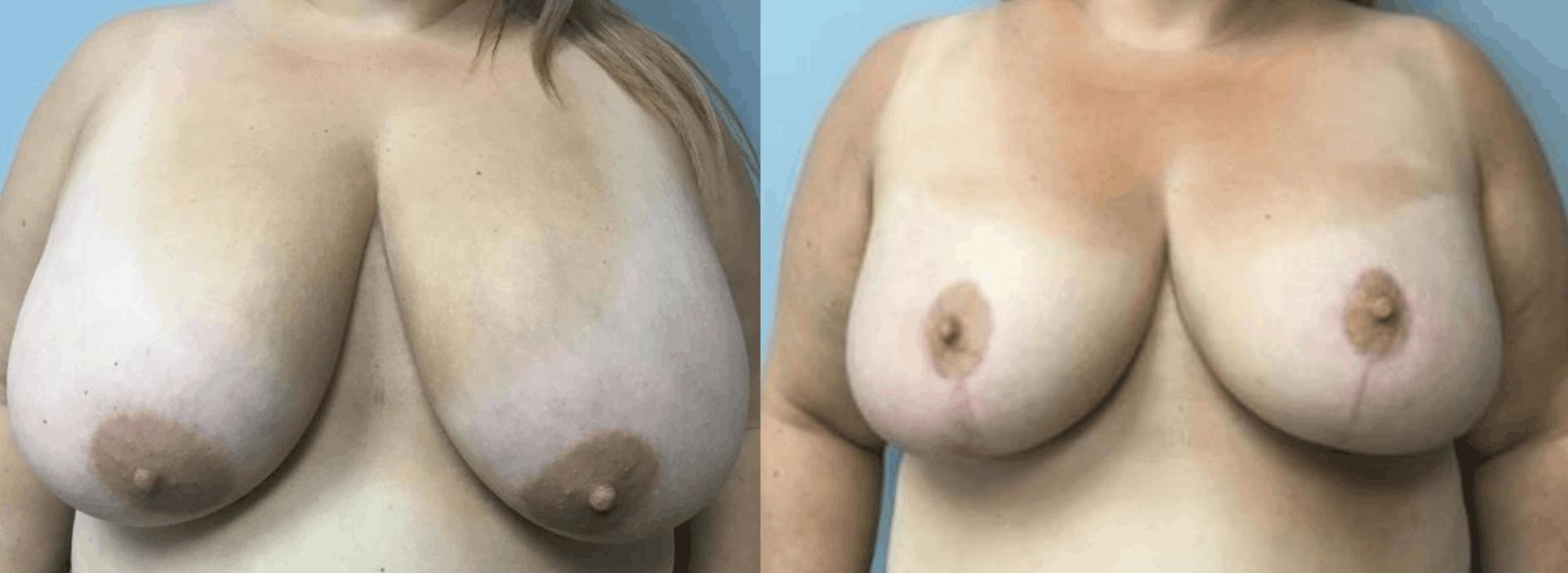 John Reilly MD Plastic Surgeon breast reduction result — Bedford, NH