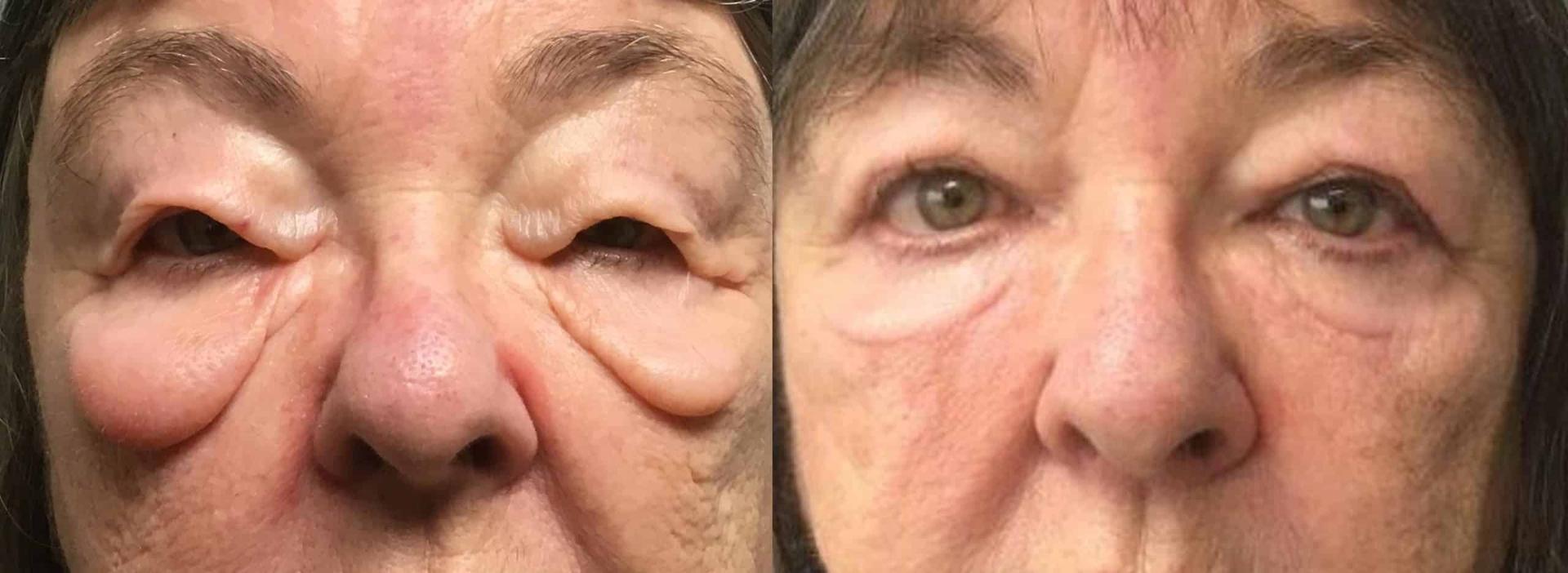John Reilly MD Plastic Surgeon eyelid lift result — Bedford, NH